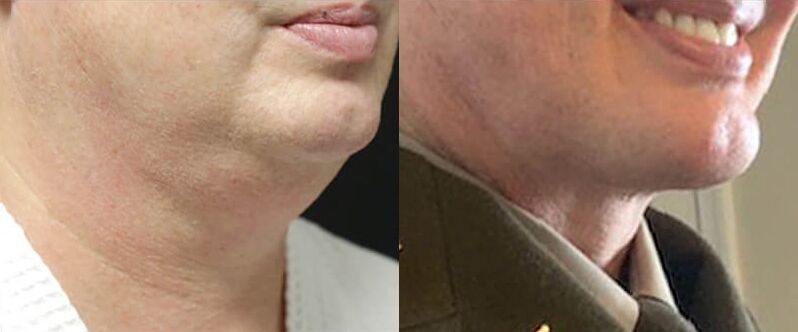 Neck Lift before and after photos by Sherber and Rad in Washington, DC