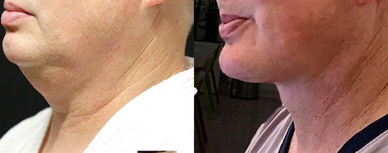 Neck Lift before and after photos by Sherber and Rad in Washington, DC