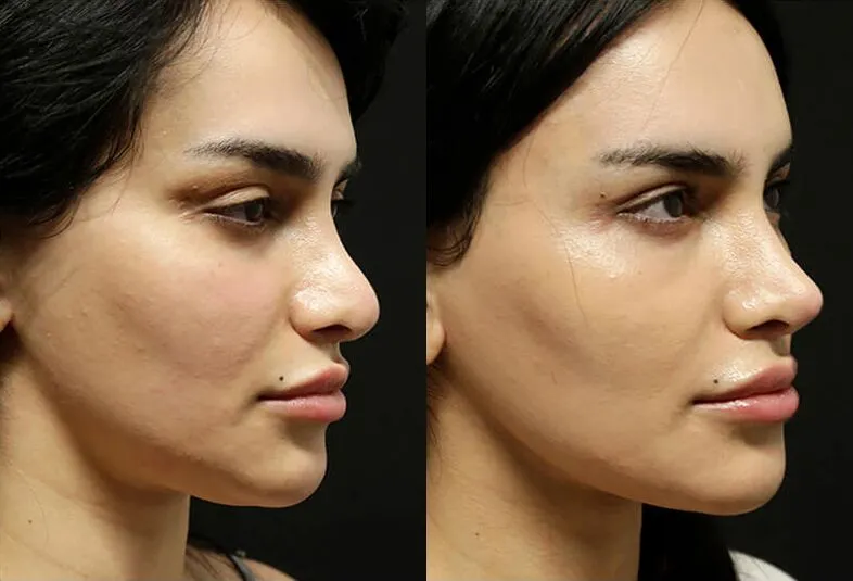 Facelift before and after photos by Sherber and Rad in Washington, DC