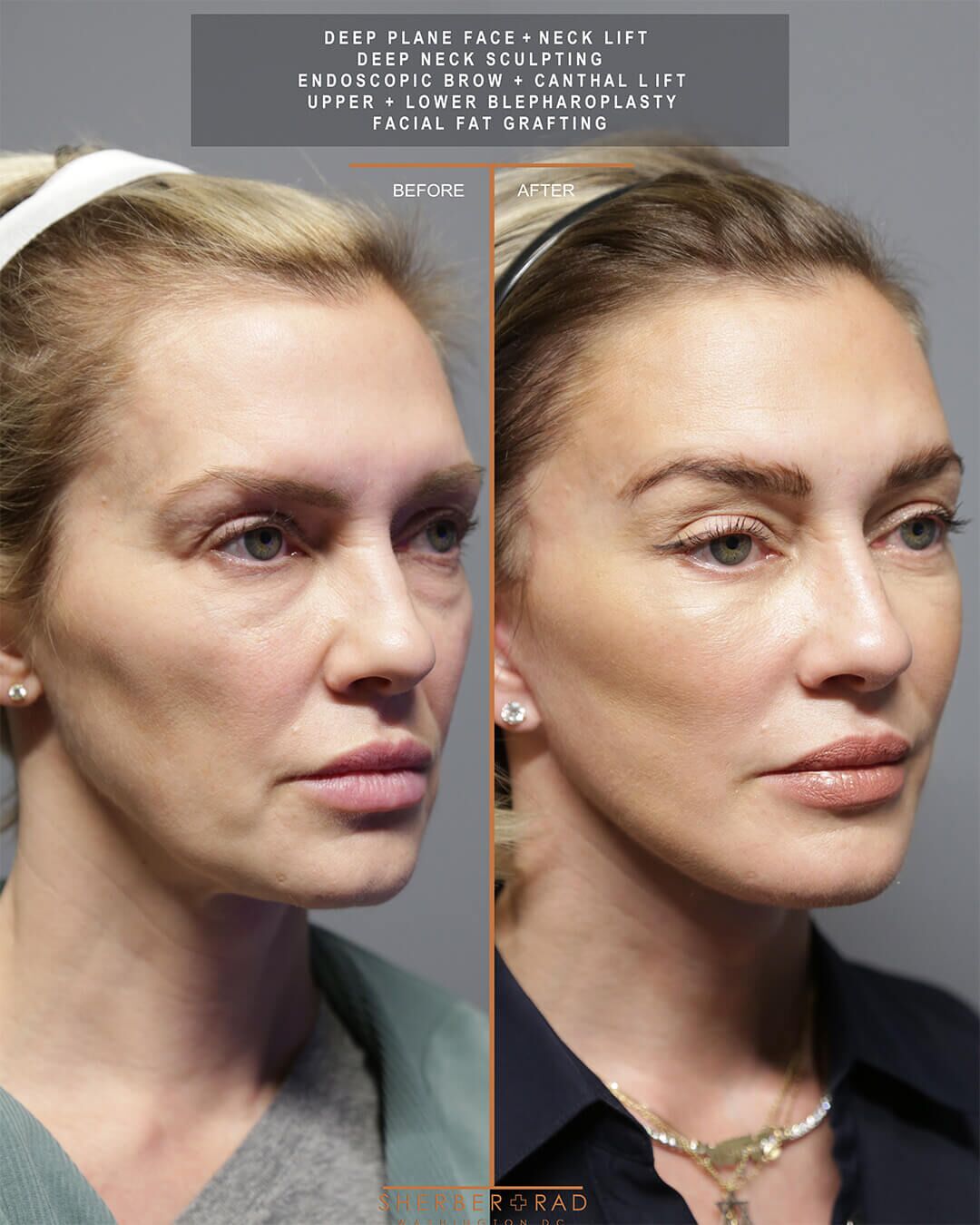 deep plane facelift before and after photos by sherber and rad in washington dc