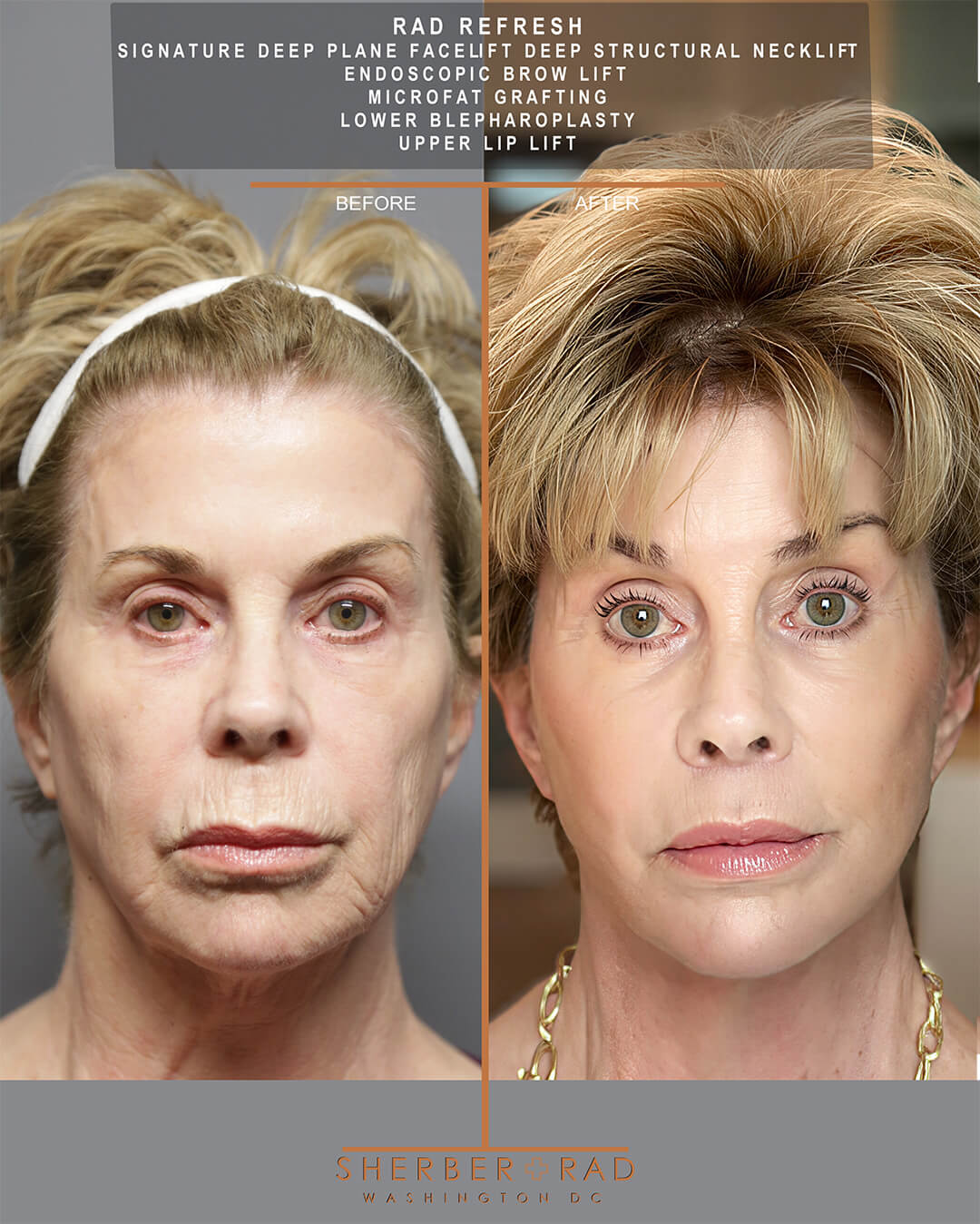 Deep Plane Facelift before and after photos by Sherber and Rad in Washington DC