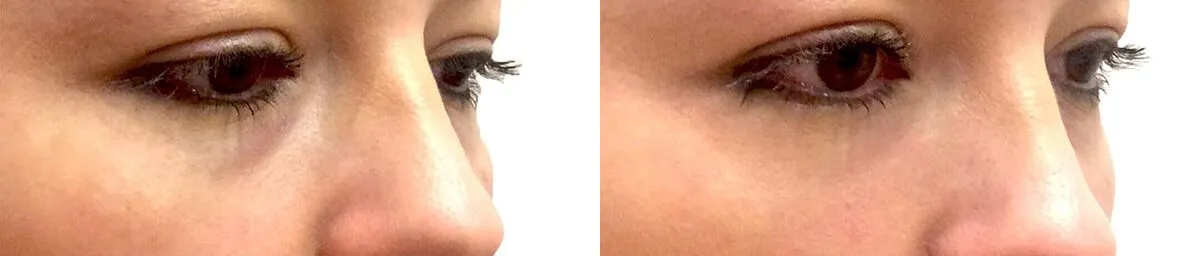Under eye Bags + Dark Circles before and after photos by Sherber and Rad in Washington, DC