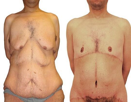 Massive Weight Loss before and after photos by Sherber and Rad in Washington, DC