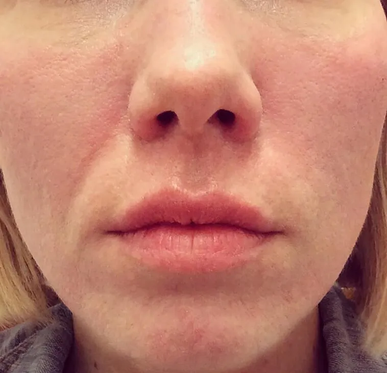 Cheek Lift + Augmentation before and after photos by Sherber and Rad in Washington, DC