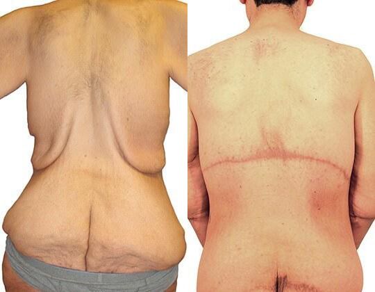Massive Weight Loss before and after photos by Sherber and Rad in Washington, DC