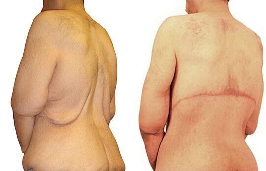 Massive Weight Loss before and after photos by Sherber and Rad in Washington, DC