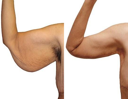 Massive Weight Loss before and after photos by Sherber and Rad in Washington, DC