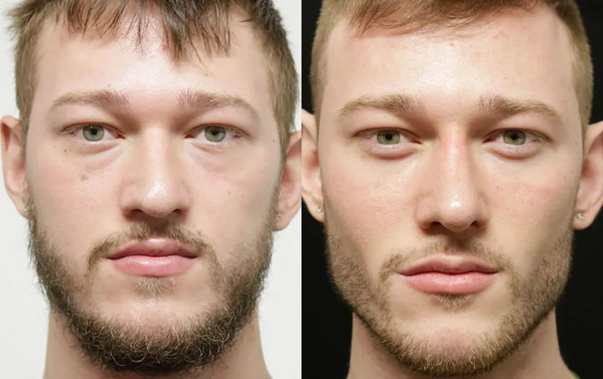 Chin + Jaw Reshaping before and after photos by Sherber and Rad in Washington, DC