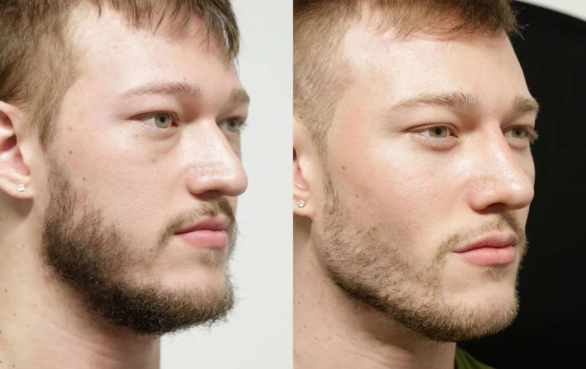 Chin + Jaw Reshaping before and after photos by Sherber and Rad in Washington, DC