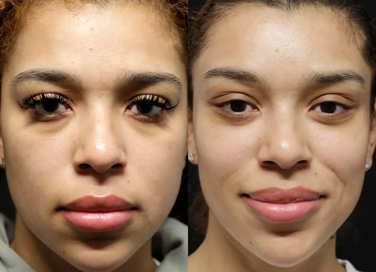 Brow + Forehead Lift before and after photos by Sherber and Rad in Washington, DC