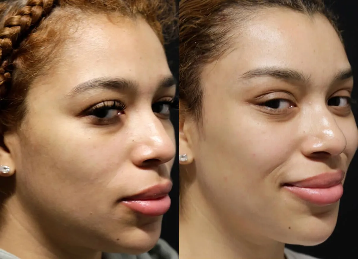 Brow + Forehead Lift before and after photos by Sherber and Rad in Washington, DC