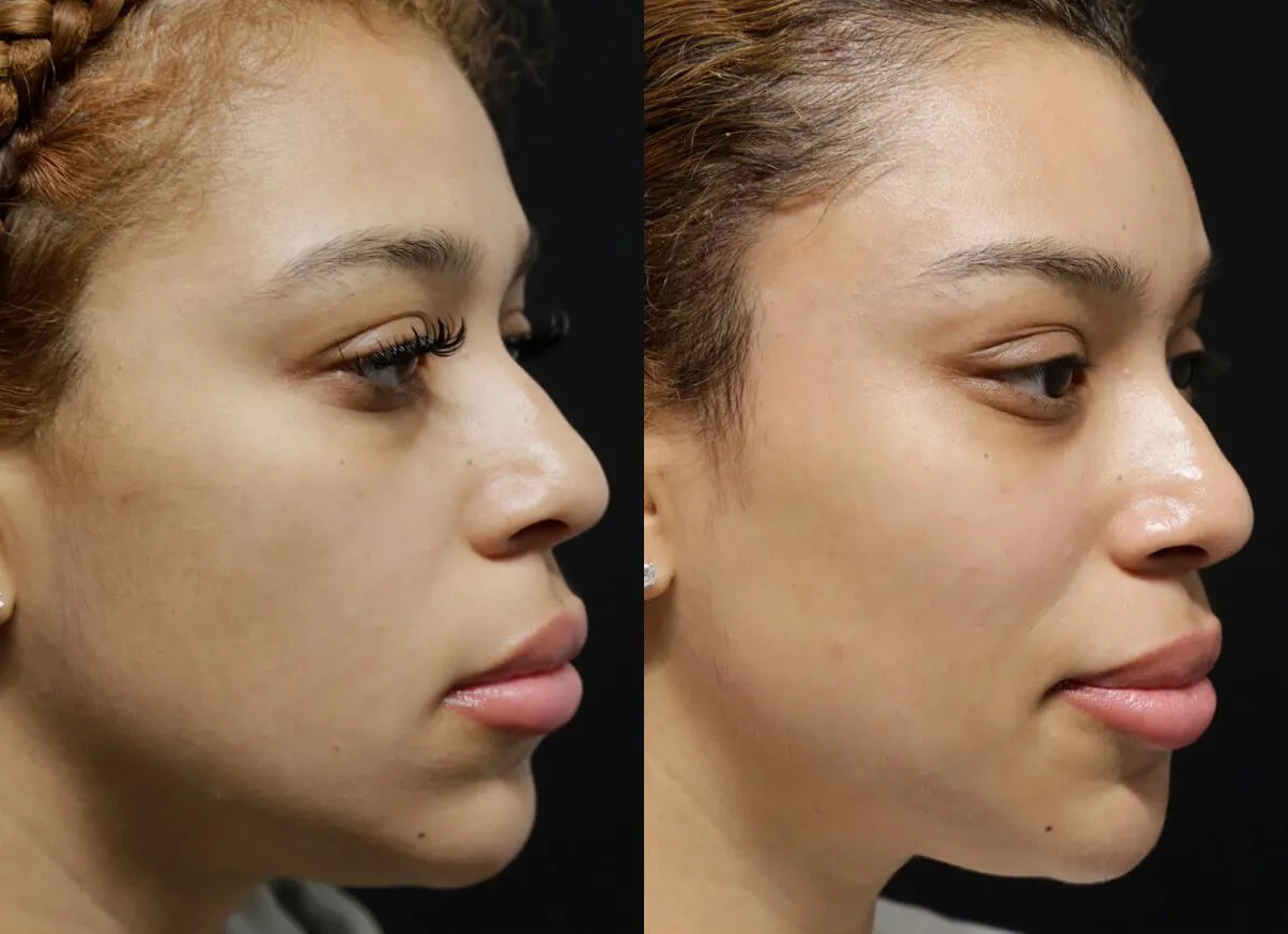 Brow + Forehead Lift before and after photos by Sherber and Rad in Washington, DC