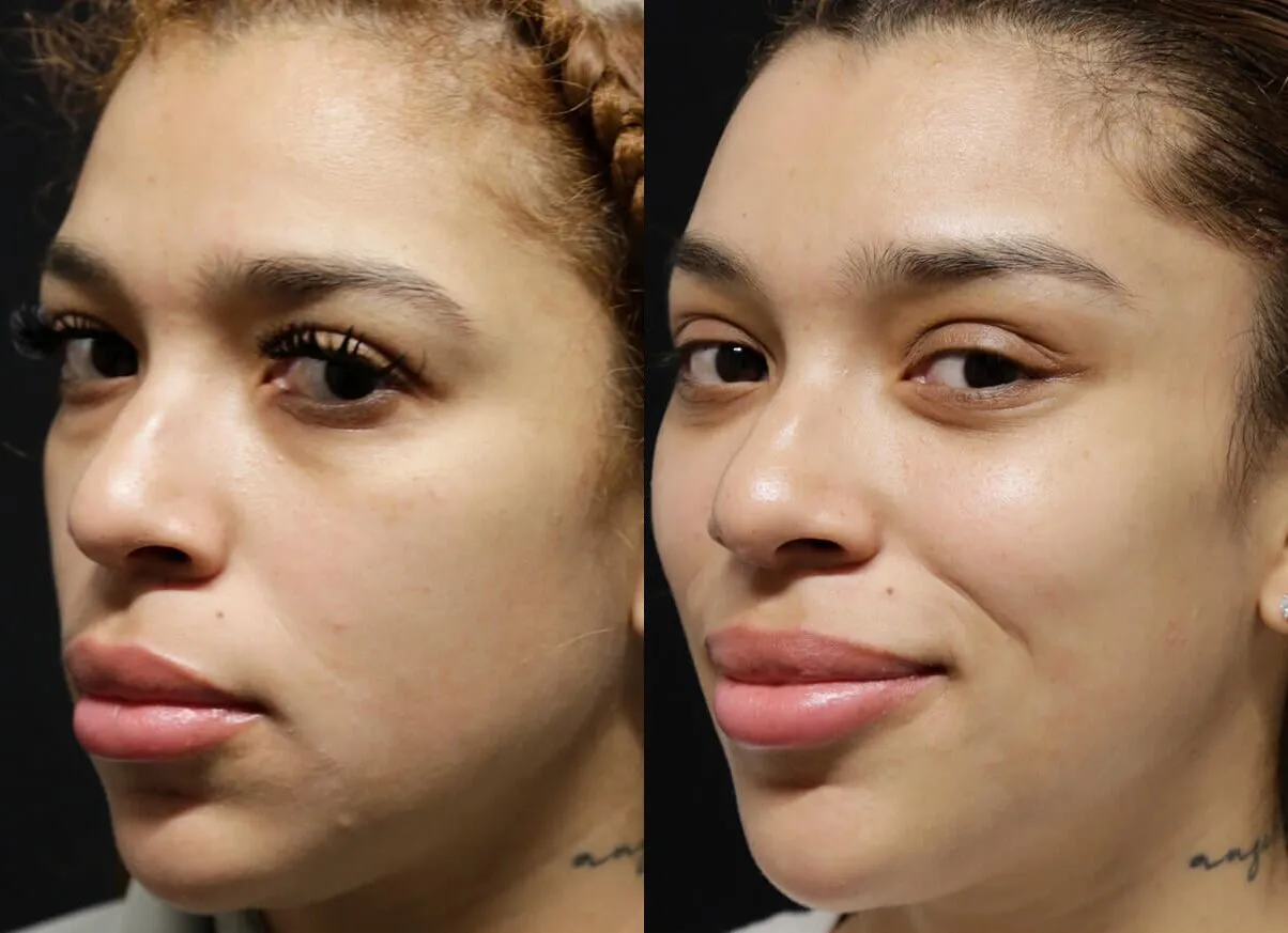 Brow + Forehead Lift before and after photos by Sherber and Rad in Washington, DC