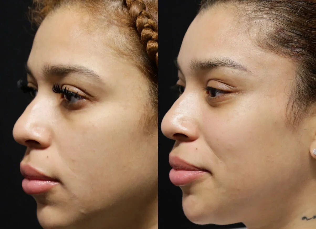 Brow + Forehead Lift before and after photos by Sherber and Rad in Washington, DC