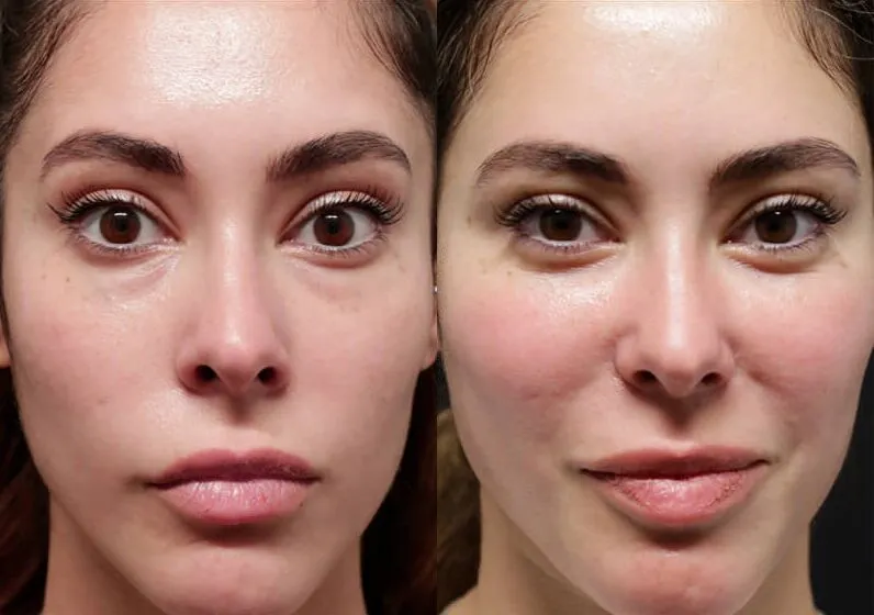 Brow + Forehead Lift before and after photos by Sherber and Rad in Washington, DC