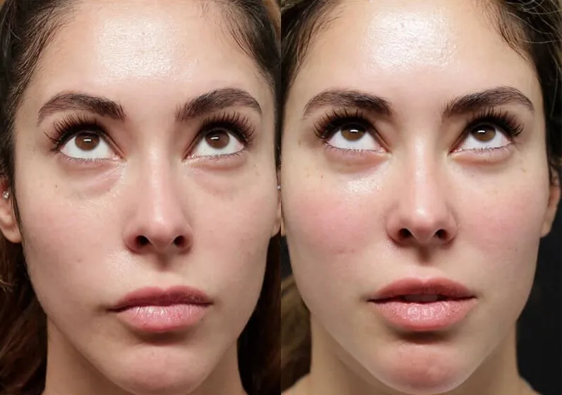 Brow + Forehead Lift before and after photos by Sherber and Rad in Washington, DC
