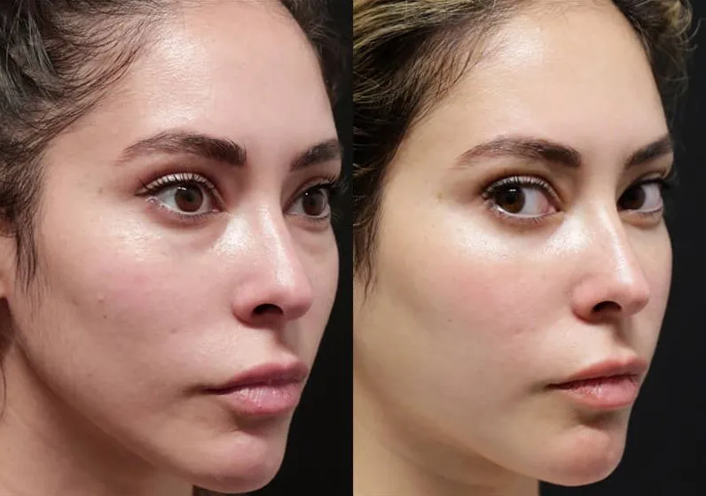 Brow + Forehead Lift before and after photos by Sherber and Rad in Washington, DC