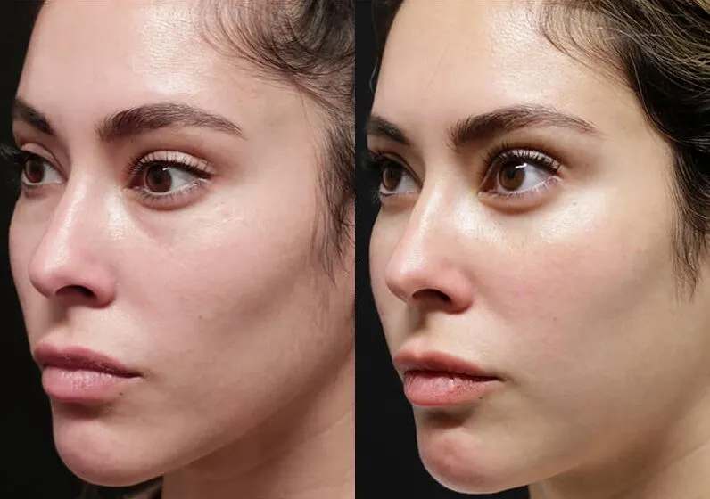 Brow + Forehead Lift before and after photos by Sherber and Rad in Washington, DC