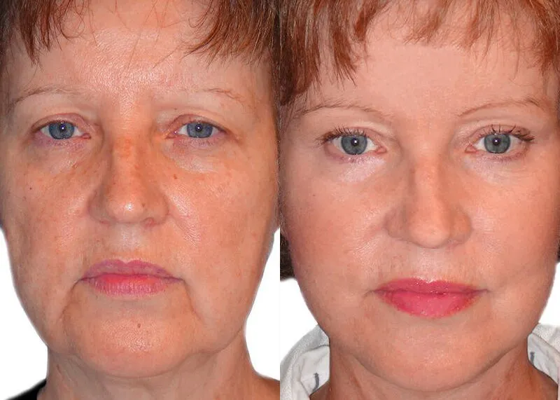 Facelift before and after photos by Sherber and Rad in Washington, DC