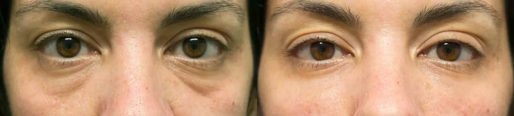 Under eye Bags + Dark Circles before and after photos by Sherber and Rad in Washington, DC