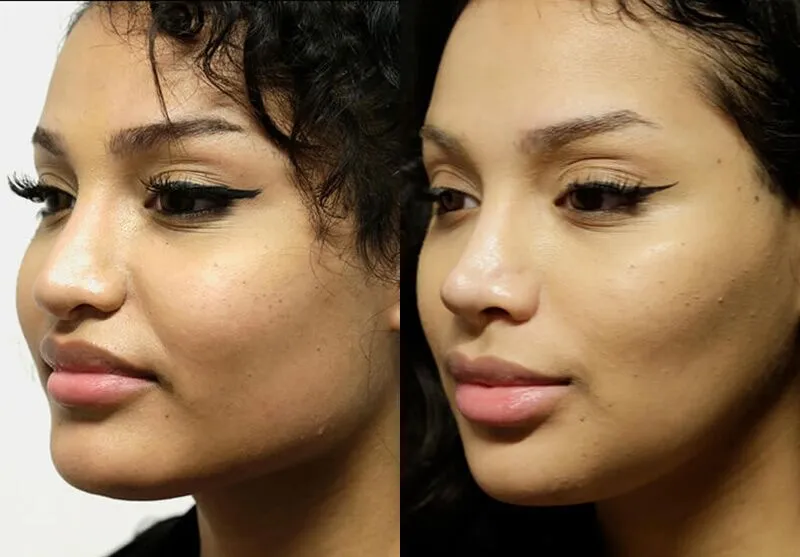 Chin + Jaw Reshaping before and after photos by Sherber and Rad in Washington, DC