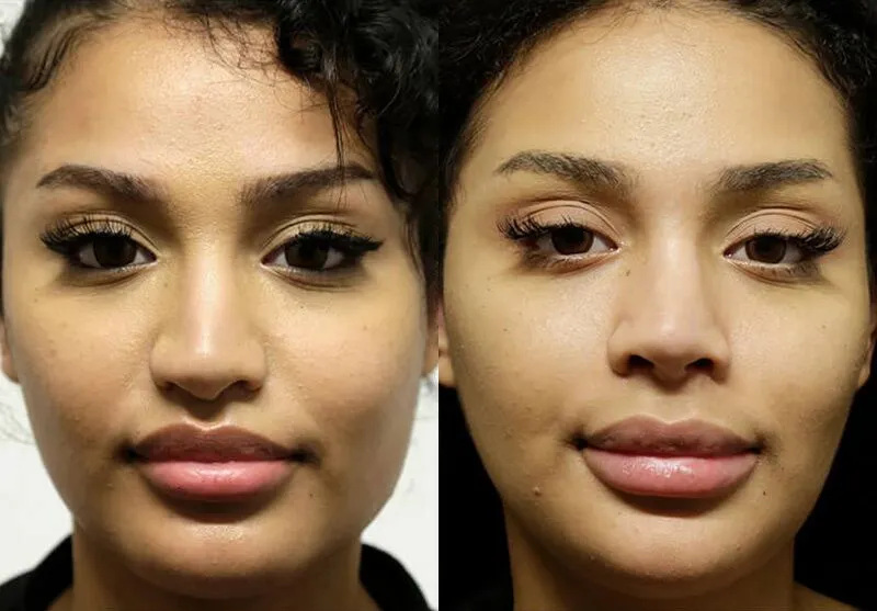 Chin + Jaw Reshaping before and after photos by Sherber and Rad in Washington, DC