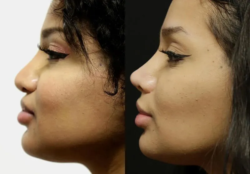 Chin + Jaw Reshaping before and after photos by Sherber and Rad in Washington, DC