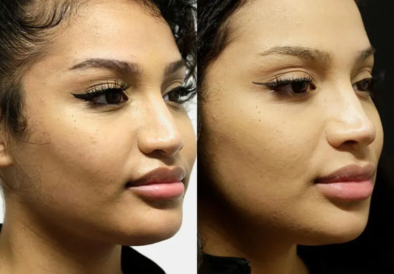 Chin + Jaw Reshaping before and after photos by Sherber and Rad in Washington, DC