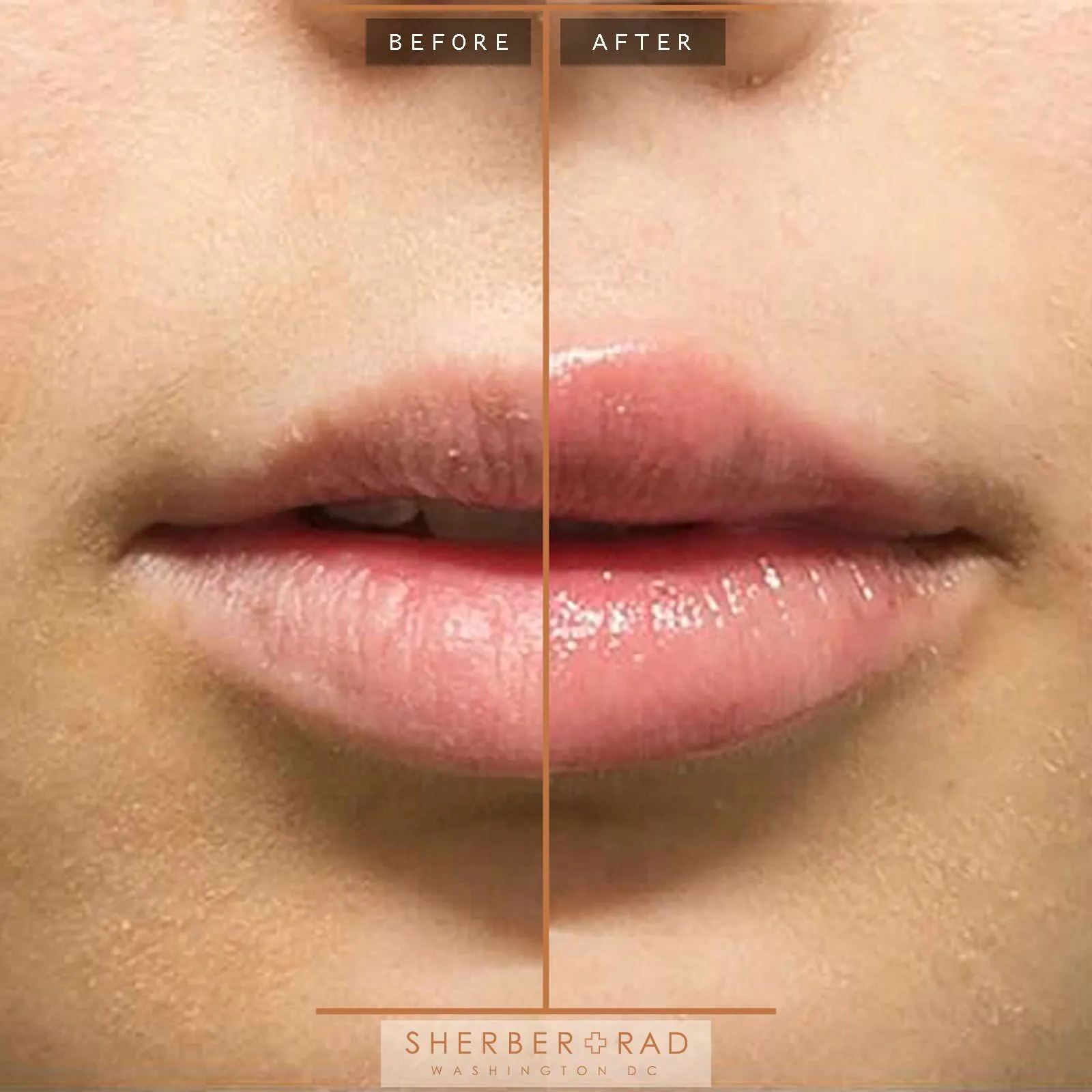 Lip Augmentation before and after photos by Sherber and Rad in Washington, DC