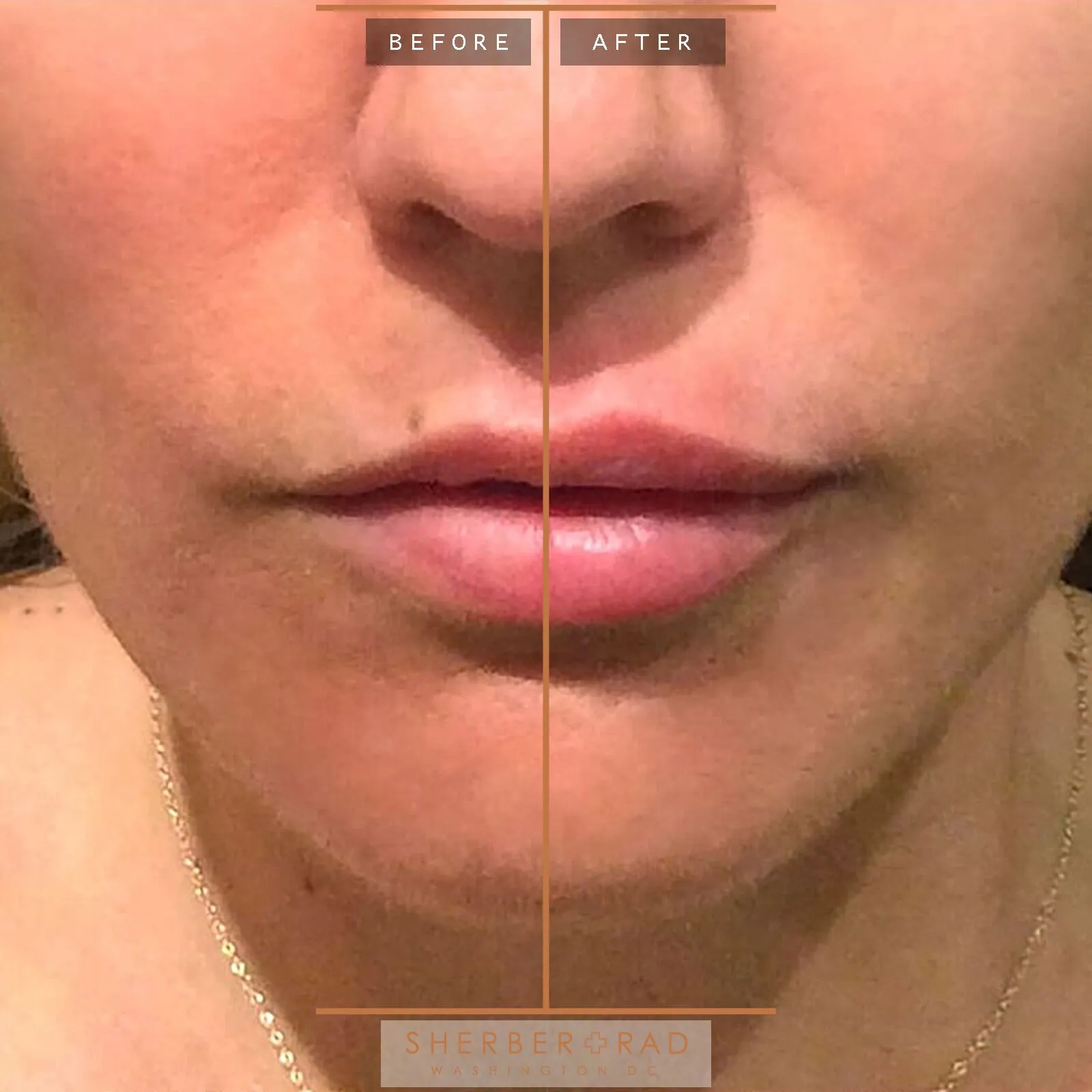 Liquid Facelift before and after photos by Sherber and Rad in Washington, DC