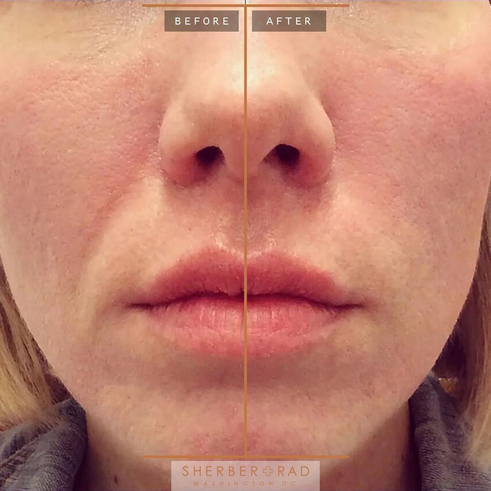 Nasolabial Folds Parentheses Lines before and after photos by Sherber and Rad in Washington, DC