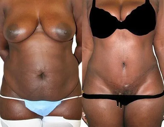 Tummy Tuck + Liposuction before and after photos by Sherber and Rad in Washington, DC