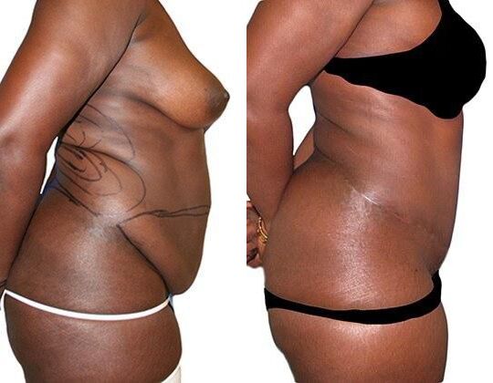 Tummy Tuck + Liposuction before and after photos by Sherber and Rad in Washington, DC