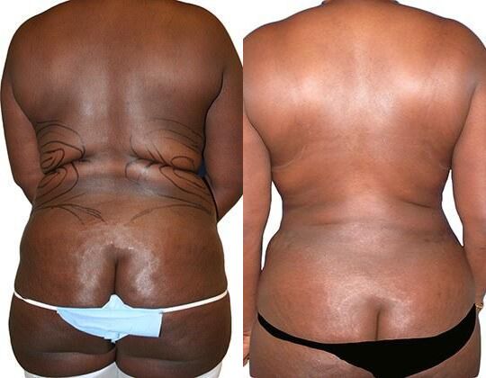 Tummy Tuck + Liposuction before and after photos by Sherber and Rad in Washington, DC