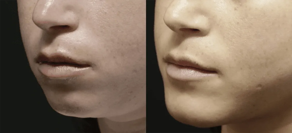 Chin + Jaw Reshaping before and after photos by Sherber and Rad in Washington, DC
