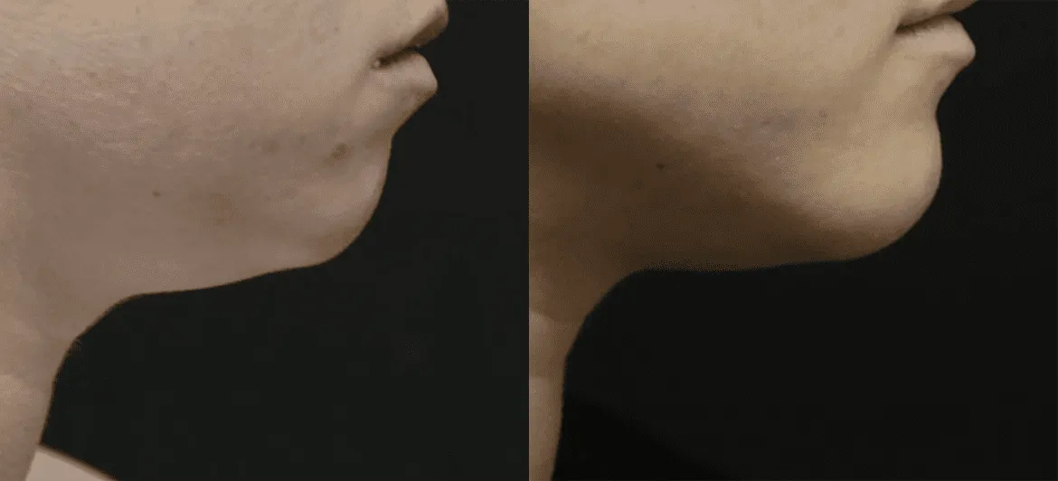 Chin + Jaw Reshaping before and after photos by Sherber and Rad in Washington, DC
