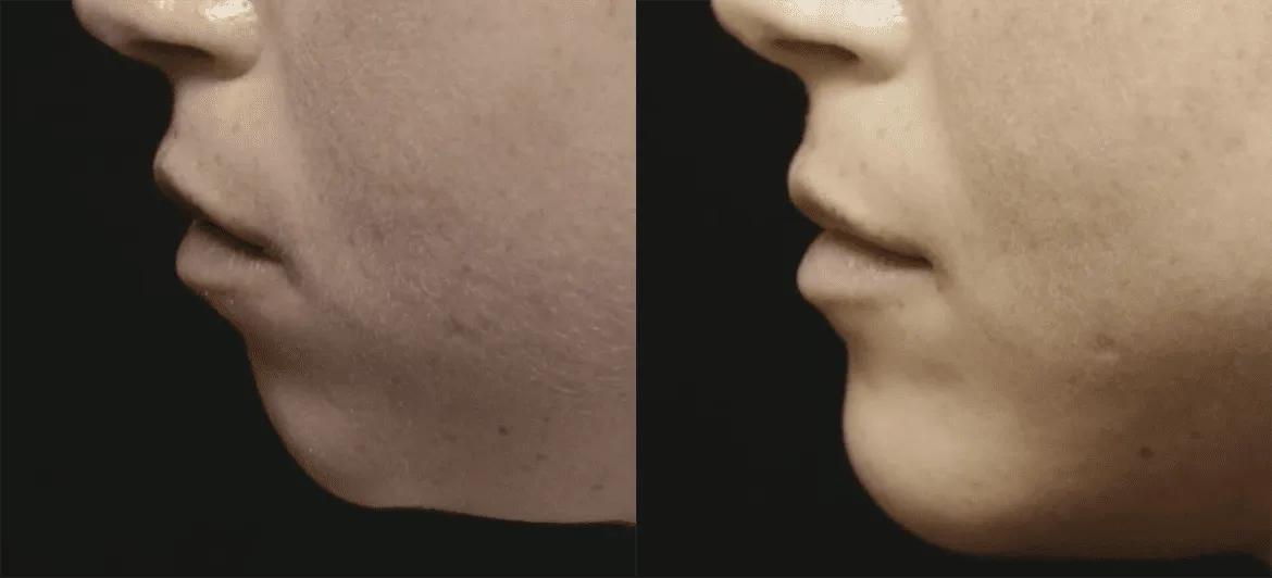 Chin + Jaw Reshaping before and after photos by Sherber and Rad in Washington, DC