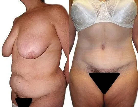 Tummy Tuck + Liposuction before and after photos by Sherber and Rad in Washington, DC