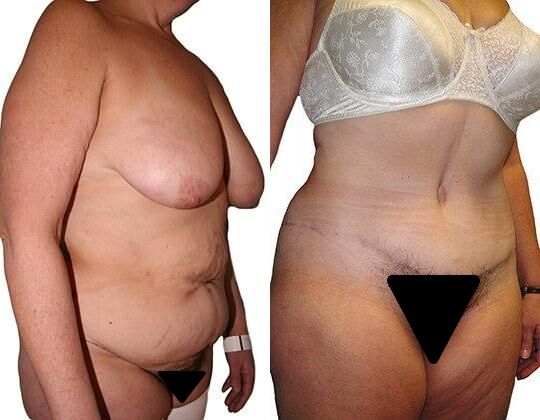 Tummy Tuck + Liposuction before and after photos by Sherber and Rad in Washington, DC