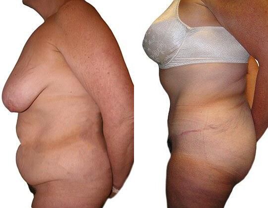 Tummy Tuck + Liposuction before and after photos by Sherber and Rad in Washington, DC