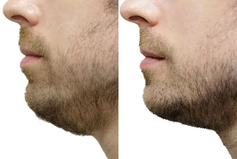 Chin + Jaw Reshaping before and after photos by Sherber and Rad in Washington, DC
