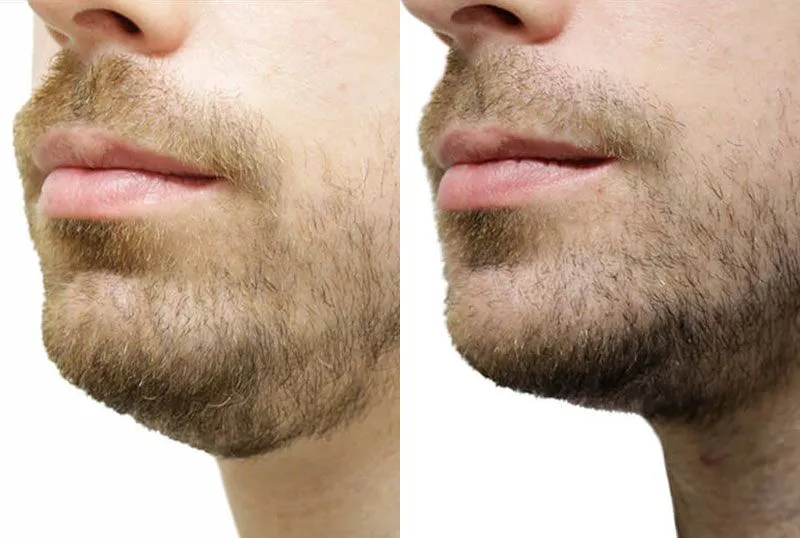 Chin + Jaw Reshaping before and after photos by Sherber and Rad in Washington, DC