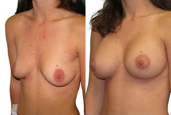 Breast Augmentation before and after photos by Sherber and Rad in Washington, DC