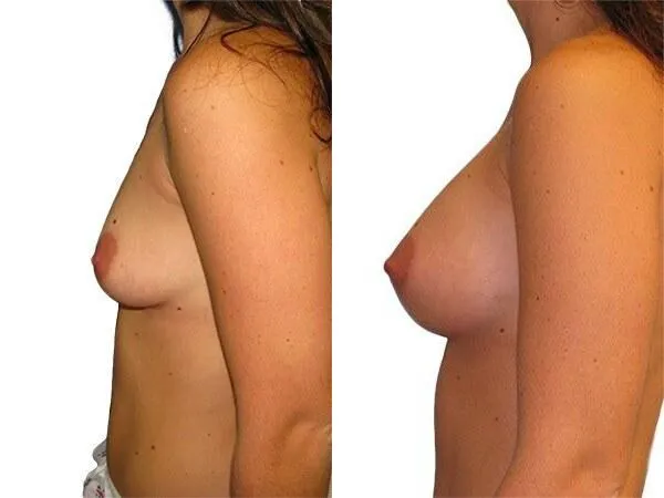 Breast Augmentation before and after photos by Sherber and Rad in Washington, DC