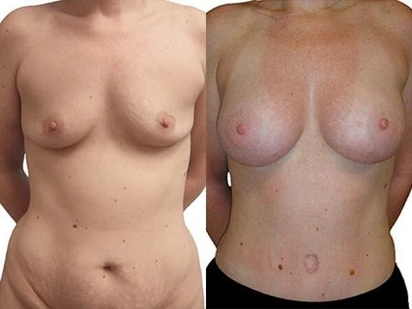 Breast Augmentation before and after photos by Sherber and Rad in Washington, DC