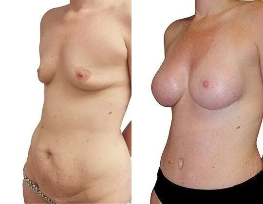 Breast Augmentation before and after photos by Sherber and Rad in Washington, DC