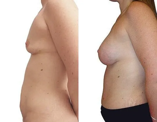 Breast Augmentation before and after photos by Sherber and Rad in Washington, DC