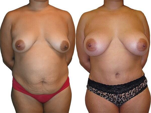 Tummy Tuck + Liposuction before and after photos by Sherber and Rad in Washington, DC
