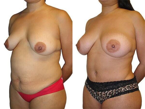 Tummy Tuck + Liposuction before and after photos by Sherber and Rad in Washington, DC