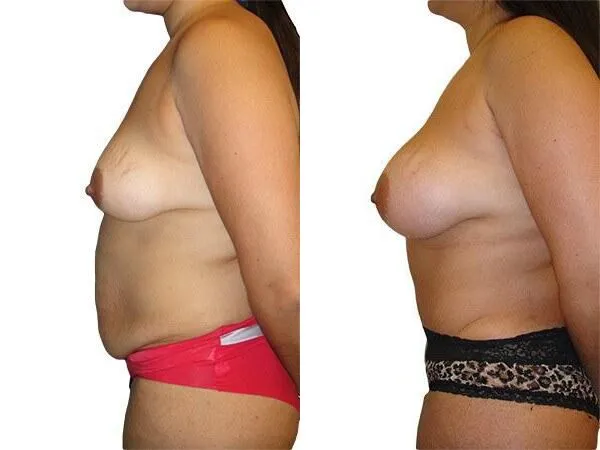 Tummy Tuck + Liposuction before and after photos by Sherber and Rad in Washington, DC